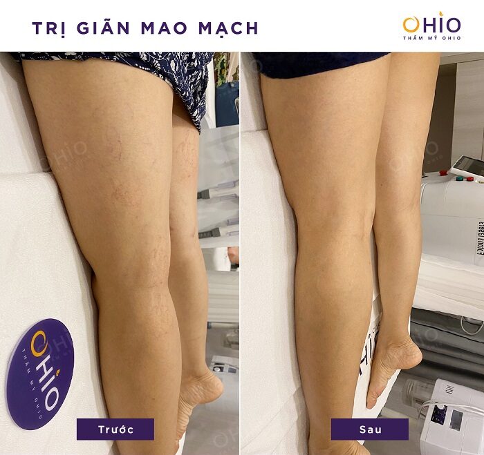 Hiệu quả trị giãn mao mạch của khách hàng tại OHIO