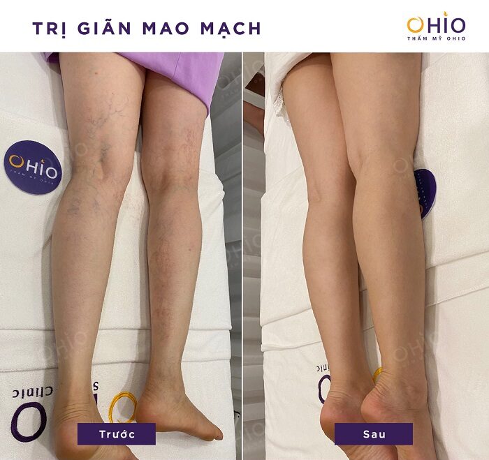 Hiệu quả trị giãn mao mạch tại OHIO