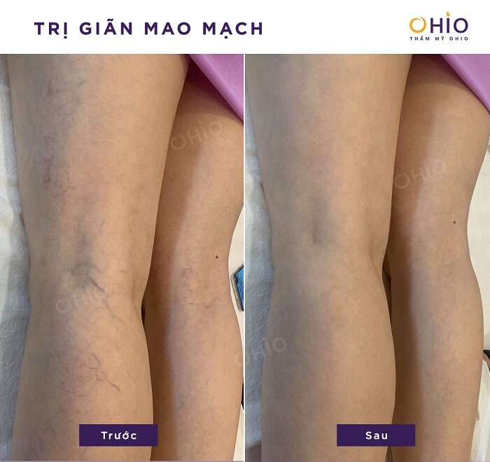 Hiệu quả trị giãn mao mạch triệt để tại OHIO