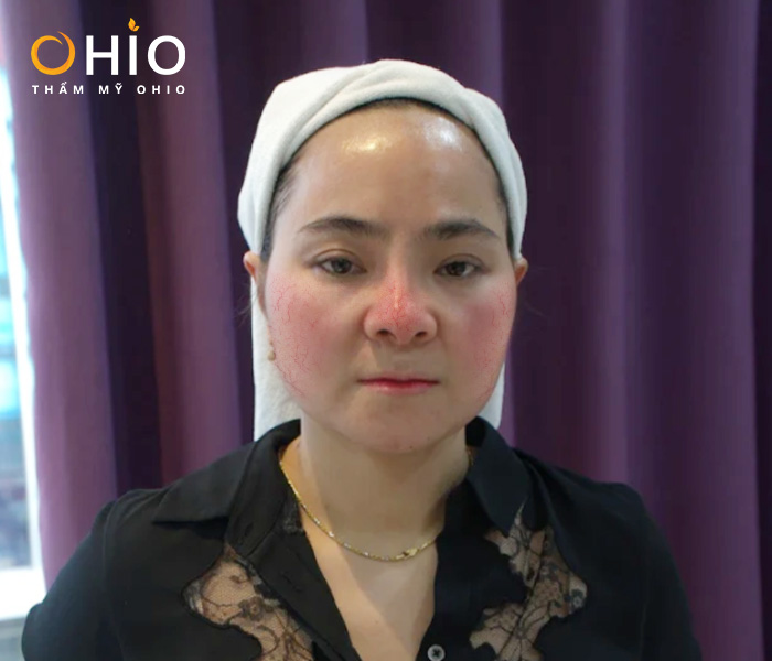 Giãn mao mạch vùng mũi đem lại nhiều phiền toán