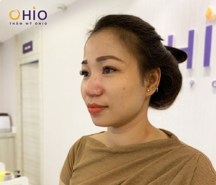 Giãn mao mạch vùng mũi khá phổ biến hiện nay