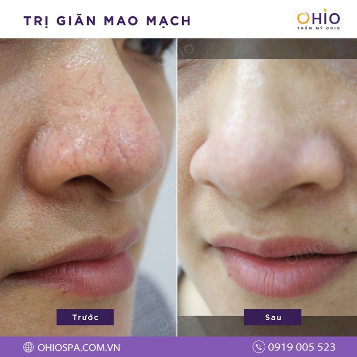 Chia sẻ bí quyết trị giãn mao mạch vùng mũi triệt để