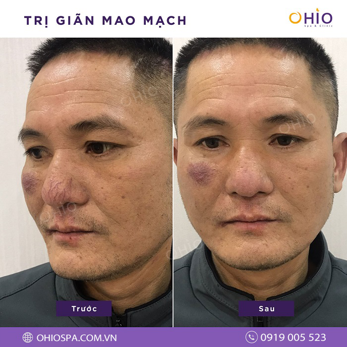 Chia sẻ bí quyết trị giãn mao mạch vùng mũi triệt để
