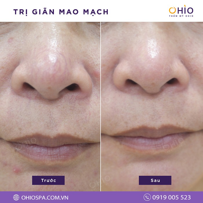 Chia sẻ bí quyết trị giãn mao mạch vùng mũi triệt để