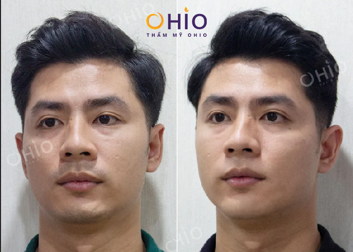 Triệt lông nam tại HCM uy tín, chất lượng tại Thẩm mỹ Ohio - Phòng khám da liễu OHIO Hiệu quả triệt râu tại thẩm mỹ Ohio