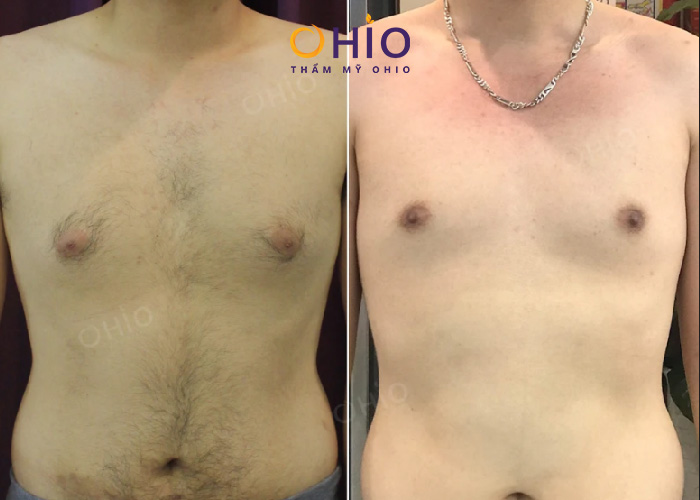 Triệt lông nam tại HCM uy tín, chất lượng tại Thẩm mỹ Ohio - Phòng khám da liễu OHIO Hiệu quả triệt lông bụng, ngực tại thẩm mỹ Ohio