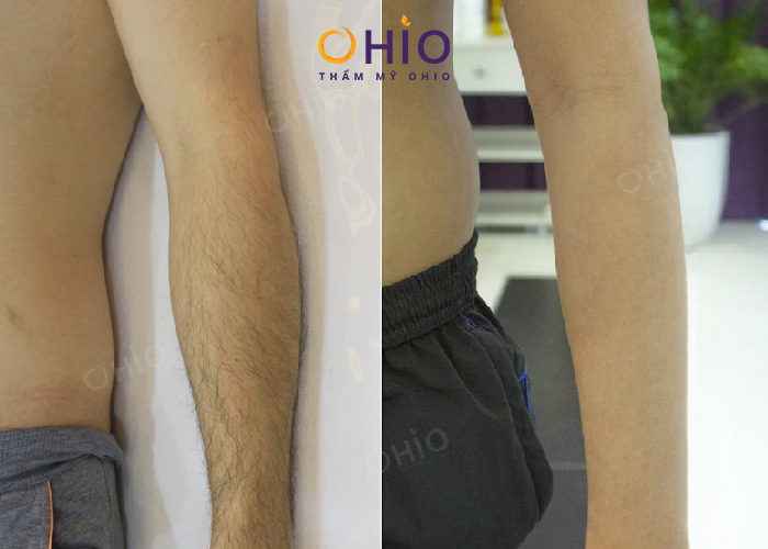 Triệt lông nam tại HCM uy tín, chất lượng tại Thẩm mỹ Ohio - Phòng khám da liễu OHIO Hiệu quả triệt lông tay tại thẩm mỹ Ohio