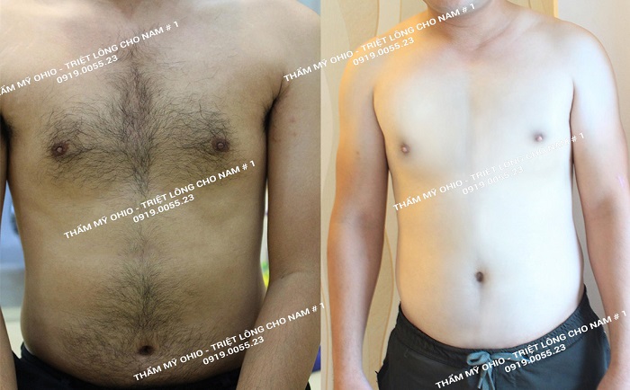 Triệt lông nam tại Sài Gòn ở đâu thì uy tín? - Phòng khám da liễu OHIO Hiệu quả triệt lông bụng, ngực của khách hàng tại Thẩm mỹ Ohio