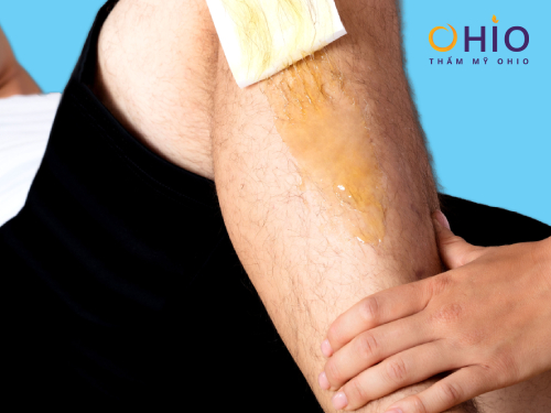 Những khốn đốn gặp phải khi Wax lông nam giới - Phòng khám da liễu OHIO Những khốn đốn gặp phải khi Wax lông nam giới 3