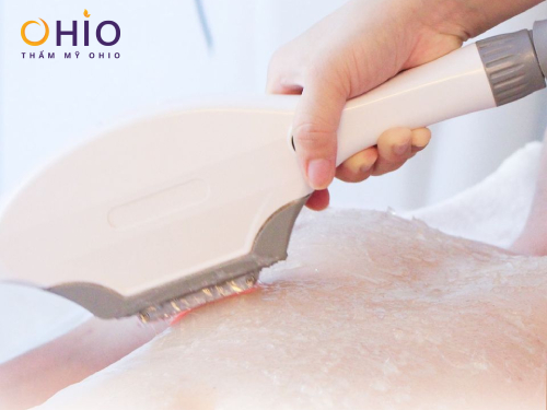 Những khốn đốn gặp phải khi Wax lông nam giới - Phòng khám da liễu OHIO Những khốn đốn gặp phải khi Wax lông nam giới 4