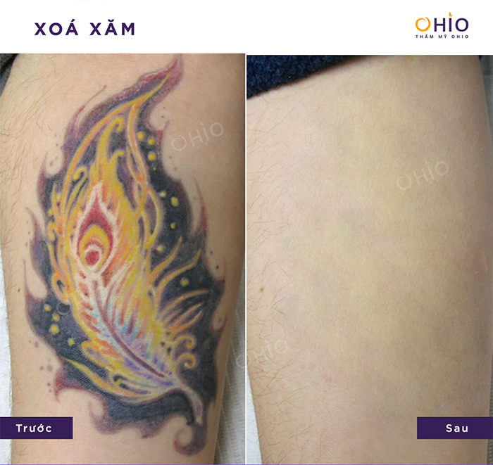 xoá xăm không sẹo tại Hồ Chí Minh xoá xăm không sẹo tại Hồ Chí Minh