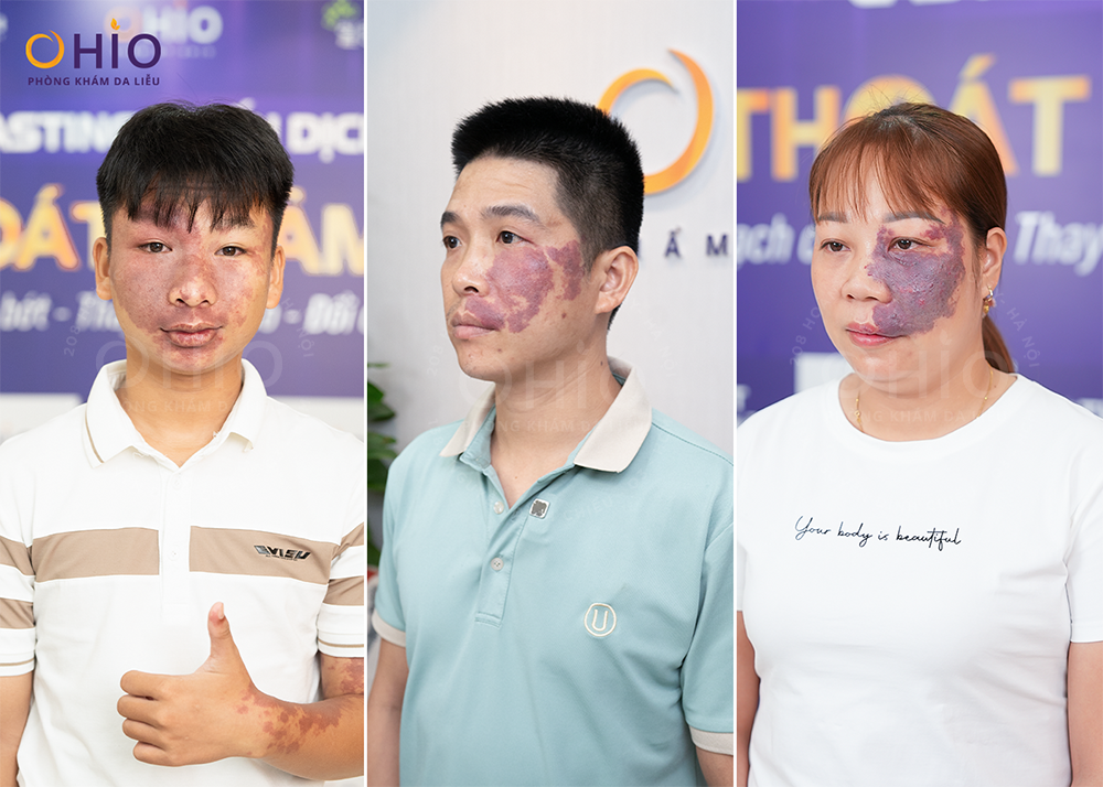 Phương pháp xóa chàm bớt đỏ, u máu hiệu quả và an toàn - Phòng khám da liễu OHIO Phương pháp xóa chàm bớt đỏ, u máu hiệu quả và an toàn