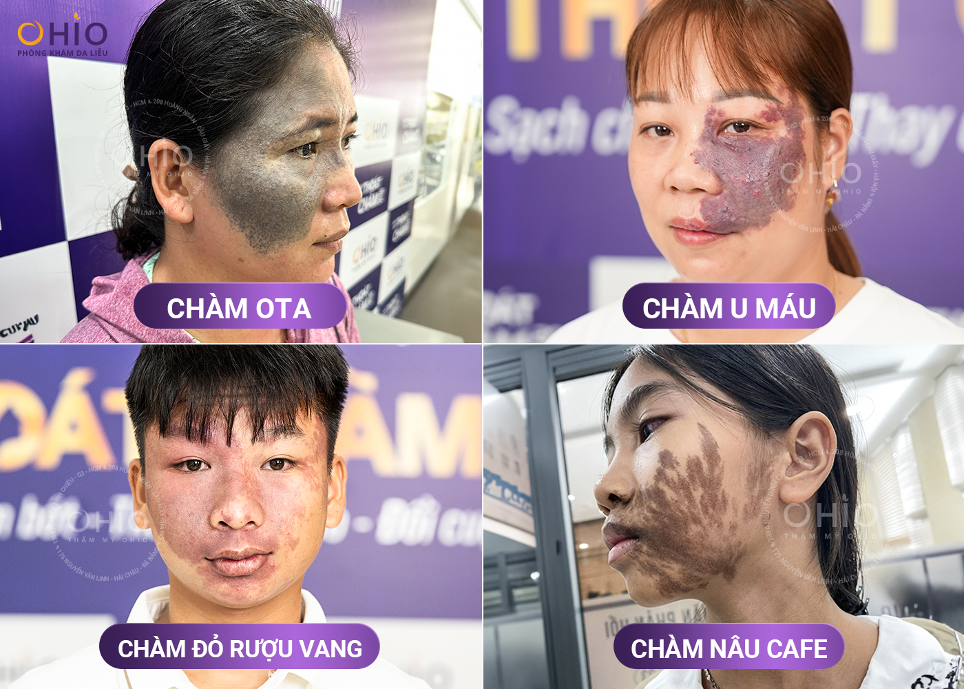 XÓA CHÀM BỚT CÓ ĐAU VÀ ĐỂ LẠI SẸO HAY KHÔNG? - Phòng khám da liễu OHIO XÓA CHÀM BỚT CÓ ĐAU VÀ ĐỂ LẠI SẸO HAY KHÔNG?