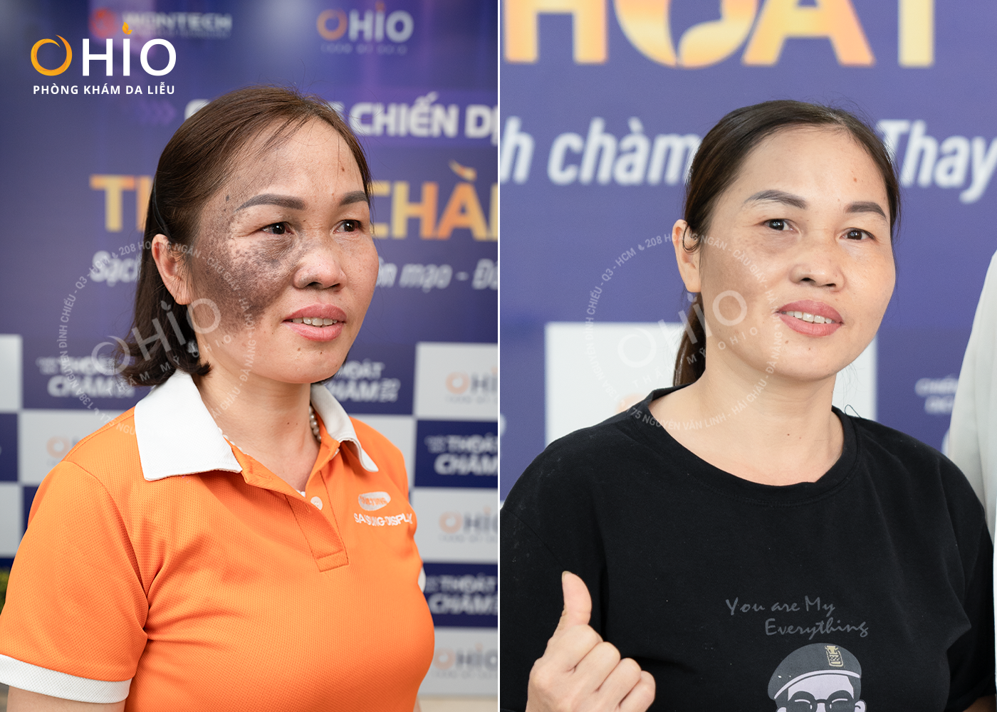 XÓA CHÀM BỚT CÓ ĐAU VÀ ĐỂ LẠI SẸO HAY KHÔNG? - Phòng khám da liễu OHIO XÓA CHÀM BỚT CÓ ĐAU VÀ ĐỂ LẠI SẸO HAY KHÔNG?