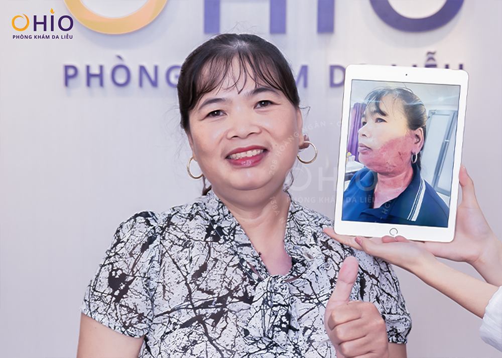 Phương pháp xóa chàm bớt đỏ, u máu hiệu quả và an toàn - Phòng khám da liễu OHIO Phương pháp xóa chàm bớt đỏ, u máu hiệu quả và an toàn
