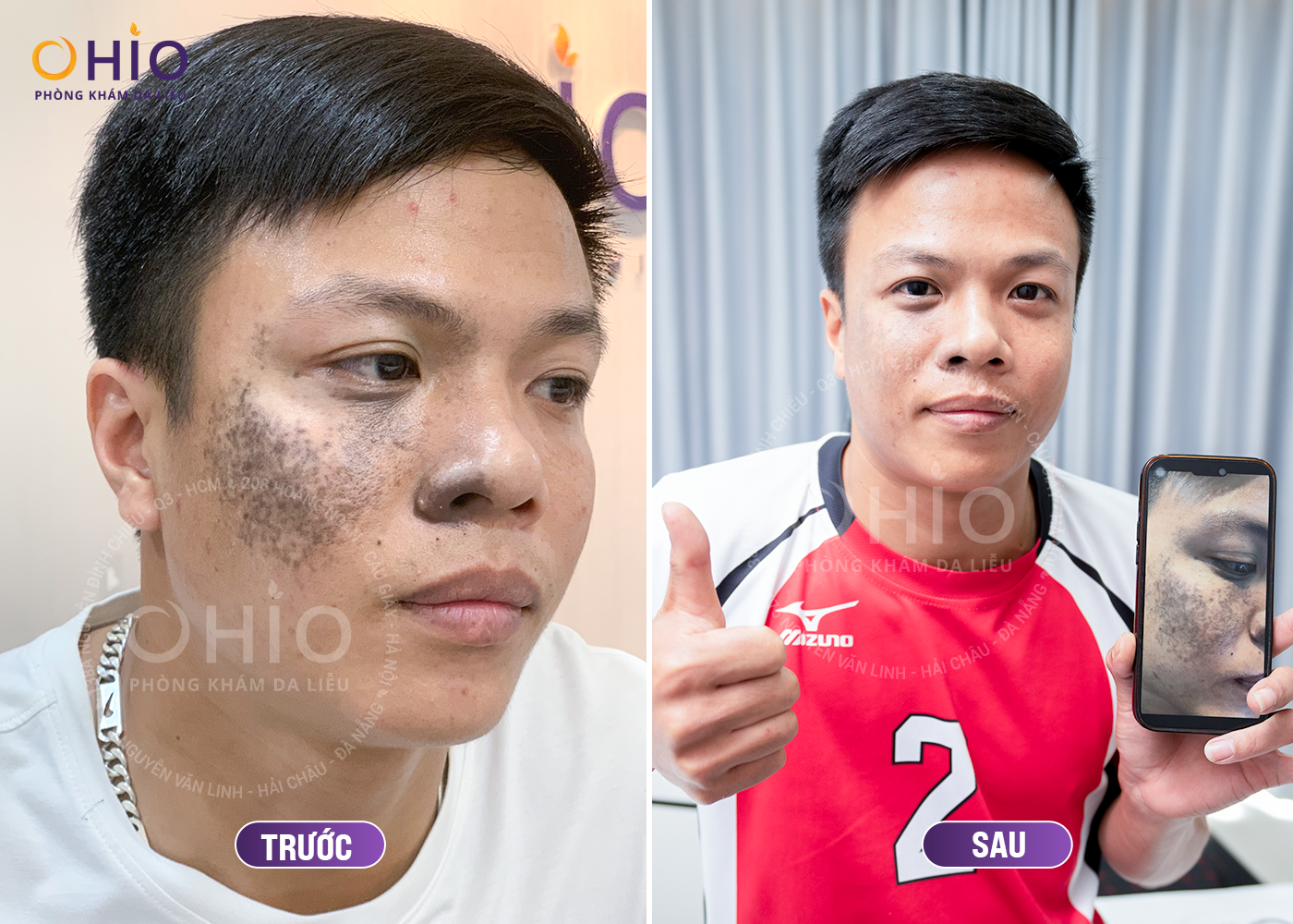 CÁCH XÓA CHÀM BỚT XANH ĐEN AN TOÀN, HIỆU QUẢ - Phòng khám da liễu OHIO CÁCH XÓA CHÀM BỚT XANH ĐEN AN TOÀN, HIỆU QUẢ