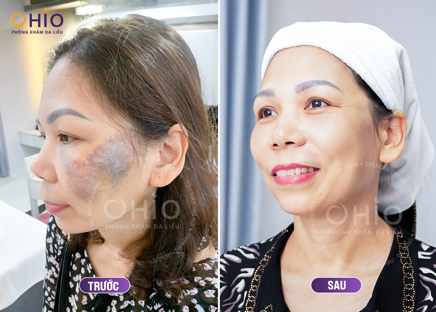 CÁCH XÓA CHÀM BỚT XANH ĐEN AN TOÀN, HIỆU QUẢ - Phòng khám da liễu OHIO CÁCH XÓA CHÀM BỚT XANH ĐEN AN TOÀN, HIỆU QUẢ