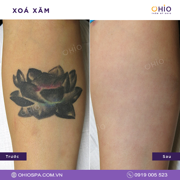 Kết quả xử lý hình xăm cũ Kết quả xử lý hình xăm cũ