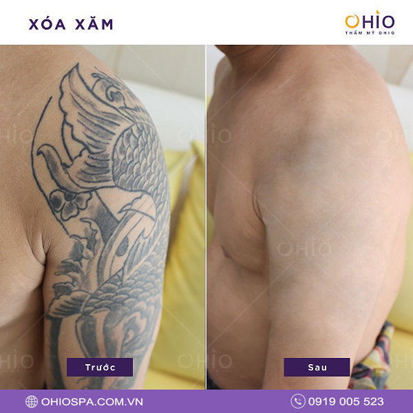 Xử lý hình xăm xấu không hợp phong thủy Xử lý hình xăm xấu không hợp phong thủy