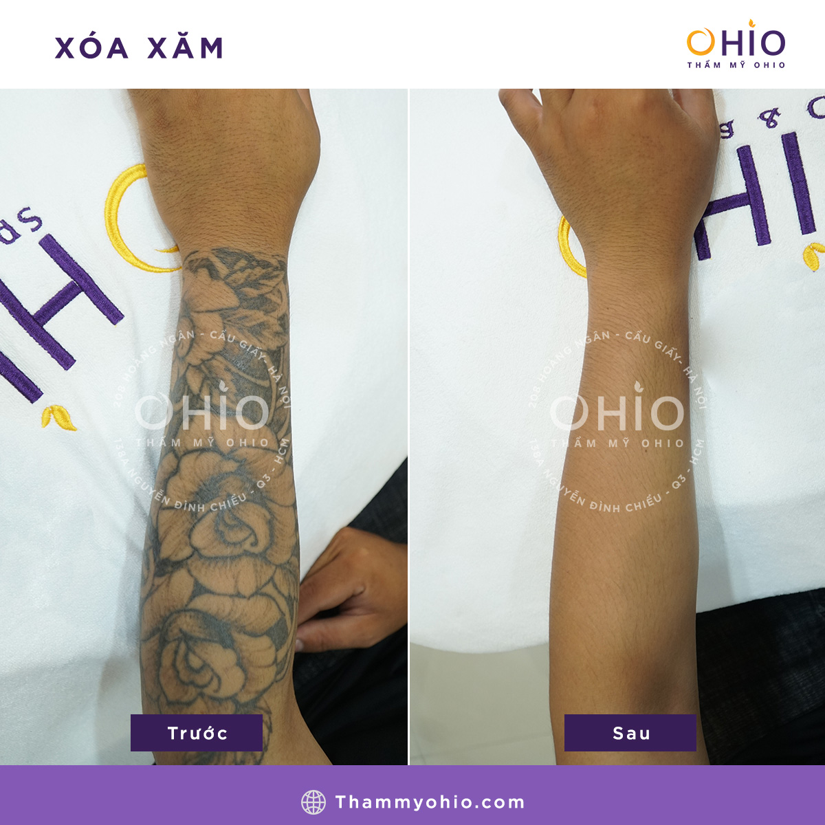 địa chỉ xóa hình xăm uy tín 5