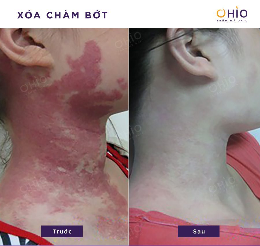 Công nghệ xóa chàm bớt tại thẩm mỹ Ohio được chuyên gia quốc tế đánh giá thế nào? - Phòng khám da liễu OHIO Công nghệ xóa chàm bớt tại thẩm mỹ Ohio được chuyên gia quốc tế đánh giá thế nào?