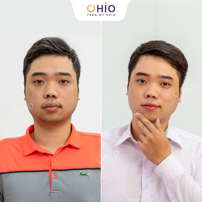 Khử thâm môi nam bằng laser bao nhiêu ngày là đẹp? - Phòng khám da liễu OHIO Khử thâm môi nam bằng laser