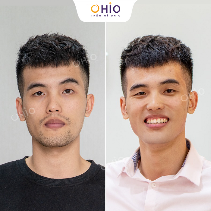 Khử thâm môi nam bằng laser bao nhiêu ngày là đẹp? - Phòng khám da liễu OHIO Khử thâm môi nam