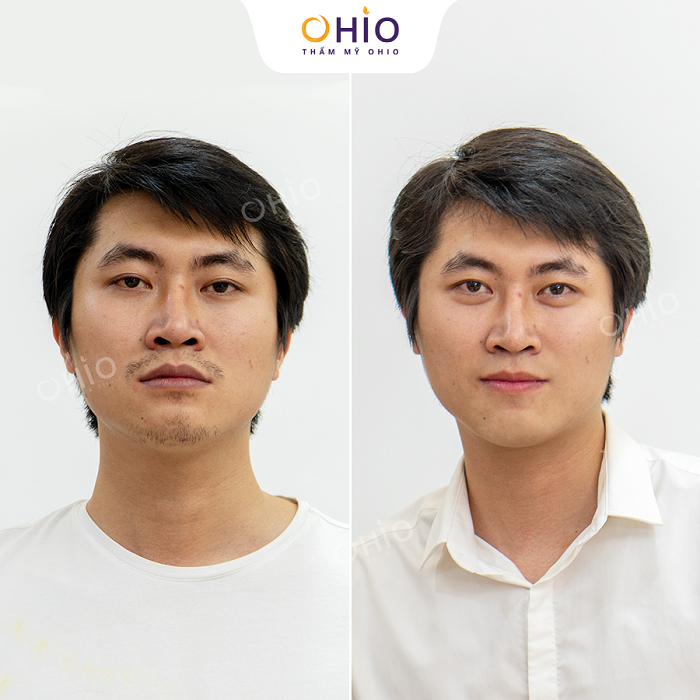 Khử thâm môi nam bằng laser bao nhiêu ngày là đẹp? - Phòng khám da liễu OHIO Khử thâm môi nam đẹp sau 15 ngày