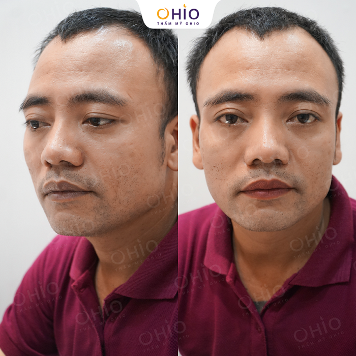 Kết quả khử thâm môi nam tại OHIO 2