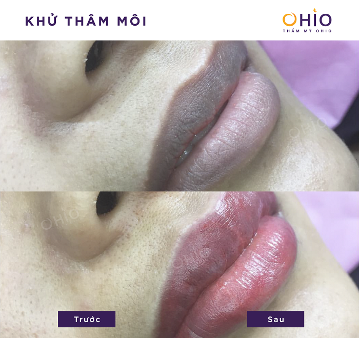 Kết quả khử thâm môi nam tại OHIO 3