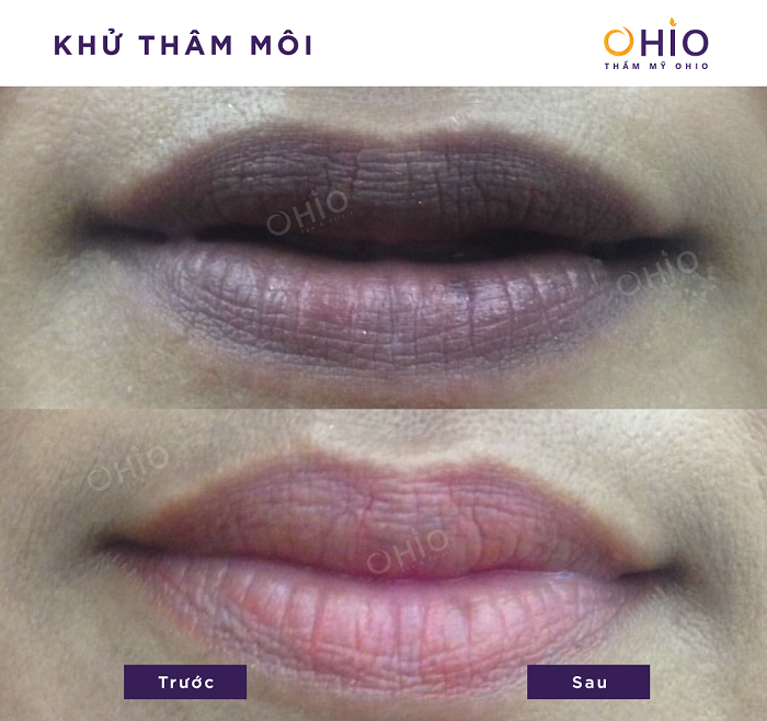 Kết quả khử thâm môi nam tại OHIO 1