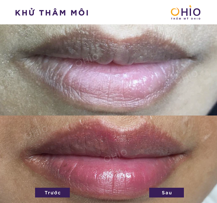 Khử thâm môi nam bằng laser bao nhiêu ngày là đẹp? - Phòng khám da liễu OHIO Kết quả khử thâm nam