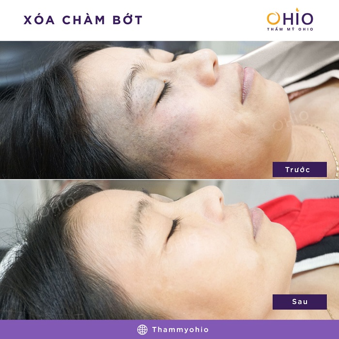 CHIẾN DỊCH XÓA CHÀM BỚT & NHỮNG THÀNH TỰU ĐÁNG NỂ NĂM 2020 - Phòng khám da liễu OHIO kết quả xóa chàm bớt thẩm mỹ ohio
