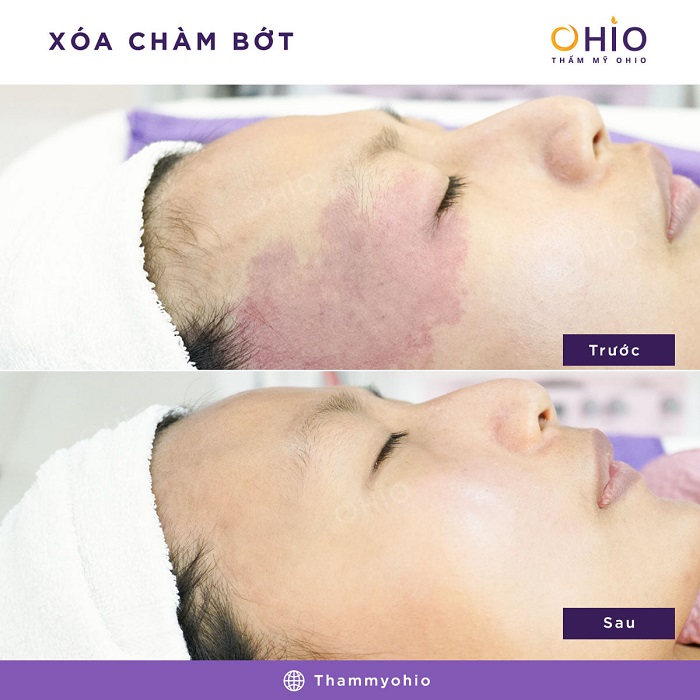 CHIẾN DỊCH XÓA CHÀM BỚT & NHỮNG THÀNH TỰU ĐÁNG NỂ NĂM 2020 - Phòng khám da liễu OHIO xóa chàm bớt đỏ