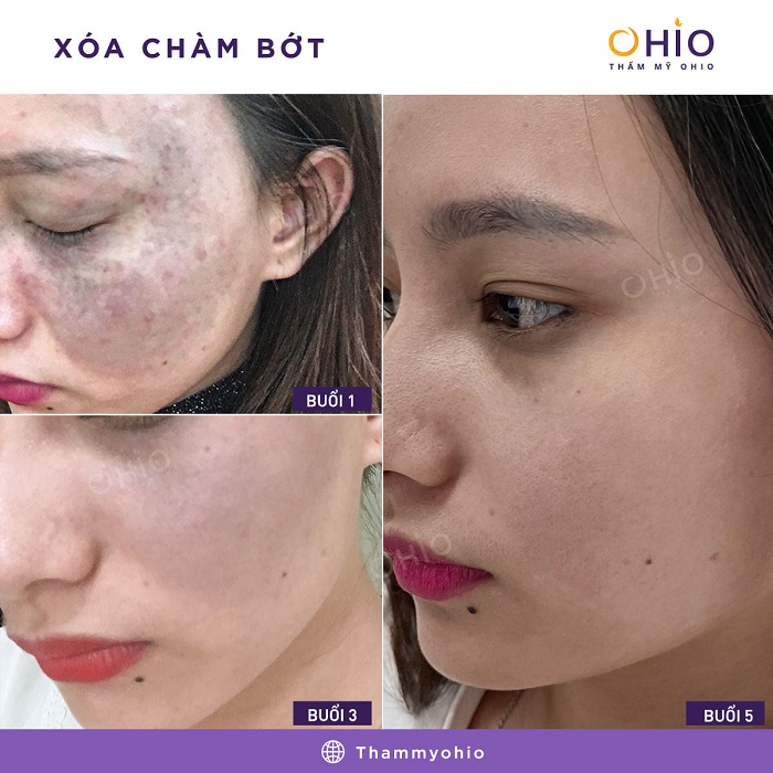 CHIẾN DỊCH XÓA CHÀM BỚT & NHỮNG THÀNH TỰU ĐÁNG NỂ NĂM 2020 - Phòng khám da liễu OHIO xóa chàm bớt xanh đen kết quả từng buổi điều trị