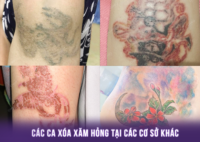 Xóa xăm hỏng nên đến đâu để xóa lại? - Phòng khám da liễu OHIO Một số ca xăm hỏng