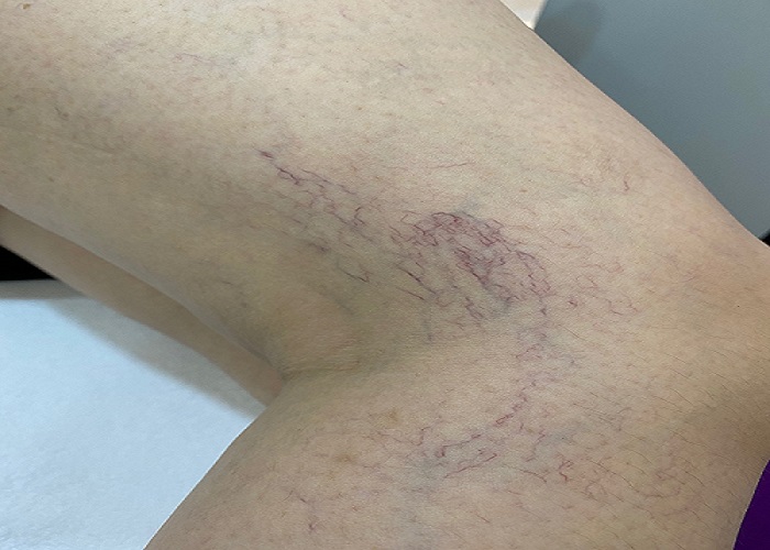 Chuyên gia giải đáp: Nguyên nhân giãn mao mạch ở nữ giới ? - Phòng khám da liễu OHIO hiện tượng giãn mao mạch ở nữ giới