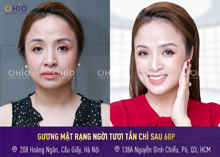 Top 5 ca trẻ hóa thay đổi ngoạn mục dưới bàn tay tài hoa bác sĩ Trịnh Trung Thực - Phòng khám da liễu OHIO trẻ hóa làn da 2