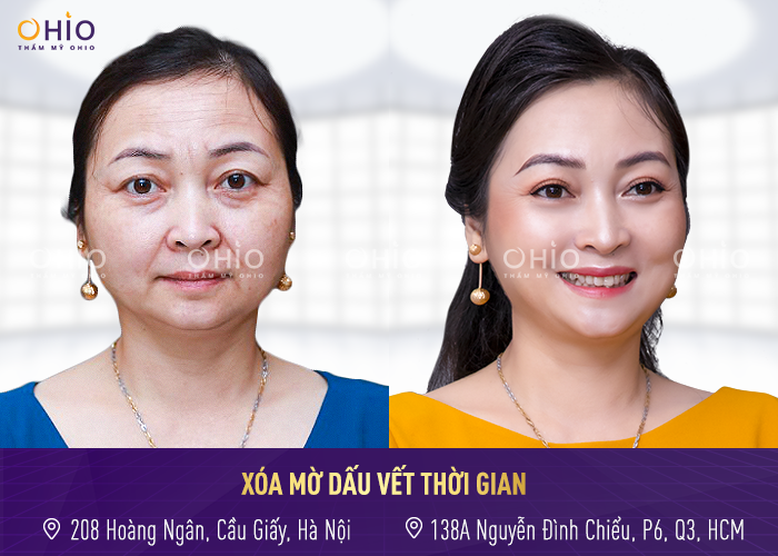 Top 5 ca trẻ hóa thay đổi ngoạn mục dưới bàn tay tài hoa bác sĩ Trịnh Trung Thực - Phòng khám da liễu OHIO trẻ hóa làn da 4