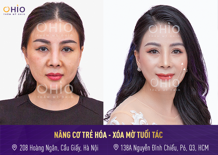 Top 5 ca trẻ hóa thay đổi ngoạn mục dưới bàn tay tài hoa bác sĩ Trịnh Trung Thực - Phòng khám da liễu OHIO trẻ hóa làn da 5