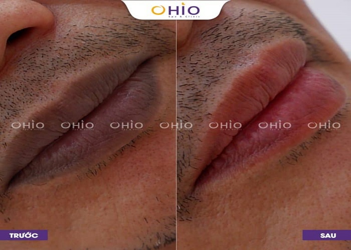 Khử thâm môi nam có khó không và cách thức tiến hành - Phòng khám da liễu OHIO Dù đôi môi khách hàng bị thâm bẩm sinh vẫn có thể khử thâm hiệu quả.