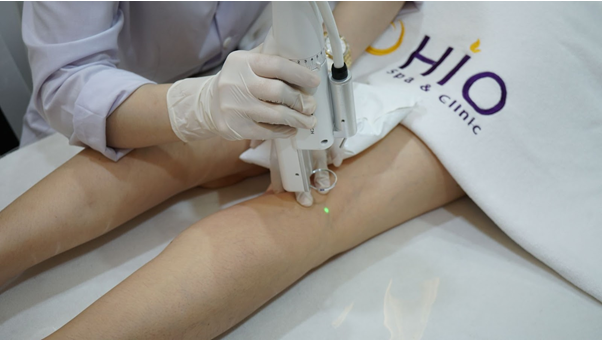 Quá trình Laser đi trên da vô cùng an toàn không có cảm giác đau rát.