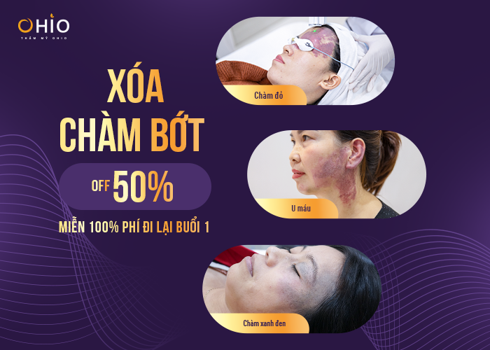 Xóa chàm toàn diện OFF 50%