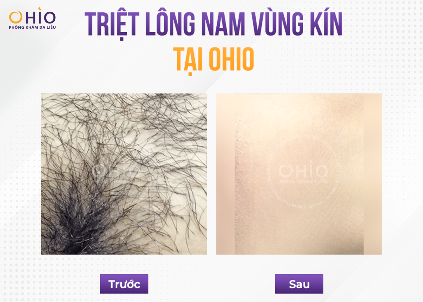 TRIỆT LÔNG VÙNG KÍN NAM AQUAMAX - XU HƯỚNG LÊN NGÔI CỦA PHÁI MẠNH - Phòng khám da liễu OHIO Hiệu quả triệt lông vùng kín tại OHIO