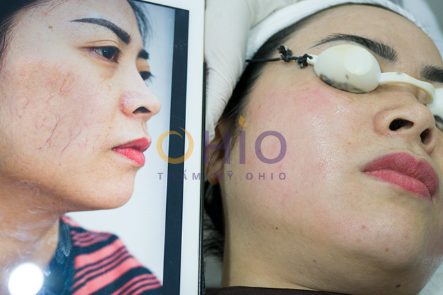 Phác đồ trị giãn mao mạch 2021 - Thành công trong điều trị chấm dứt cho người bệnh - Phòng khám da liễu OHIO Phác đồ trị giãn mao mạch 2021 - Thành công trong điều trị chấm dứt cho người bệnh