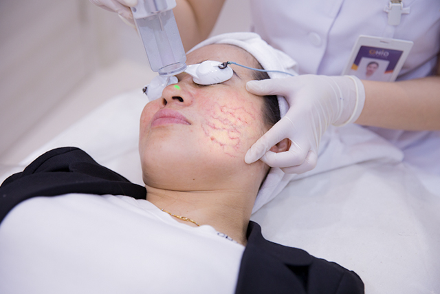 Phác đồ trị giãn mao mạch 2021 - Thành công trong điều trị chấm dứt cho người bệnh