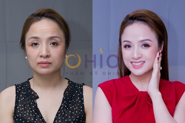 Top 5 nguyên nhân gây lão hóa da ở phụ nữ trên 35 tuổi & giải pháp trẻ hóa xóa nhăn - Phòng khám da liễu OHIO nguyên nhân gây lão hóa da 3
