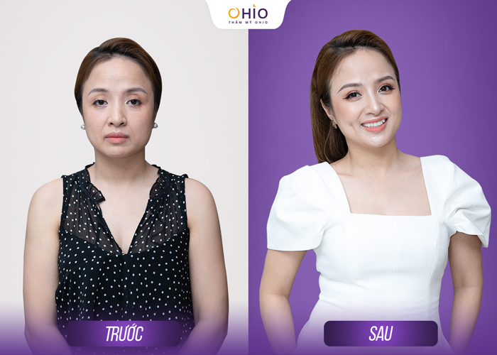 Trẻ hóa Hyper Collagen siêu phác đồ Hàn Quốc hồi sinh làn da tuổi đôi mươi - Phòng khám da liễu OHIO Trẻ hóa Hyper Collagen siêu phác đồ Hàn Quốc hồi sinh làn da tuổi đôi mươi