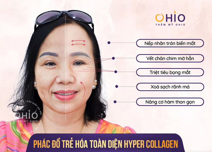 Trẻ hóa Hyper Collagen siêu phác đồ Hàn Quốc hồi sinh làn da tuổi đôi mươi - Phòng khám da liễu OHIO Trẻ hóa Hyper Collagen siêu phác đồ Hàn Quốc hồi sinh làn da tuổi đôi mươi