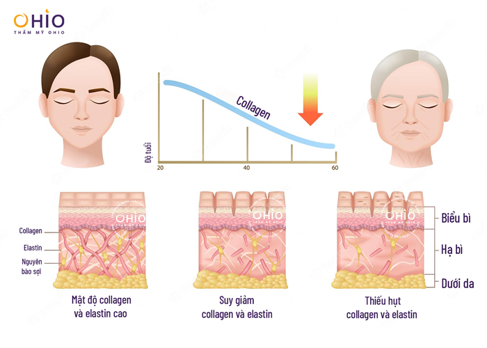Trẻ hóa Hyper Collagen siêu phác đồ Hàn Quốc hồi sinh làn da tuổi đôi mươi - Phòng khám da liễu OHIO Trẻ hóa Hyper Collagen siêu phác đồ Hàn Quốc hồi sinh làn da tuổi đôi mươi